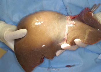 Karaciğeri de tutukladılar!