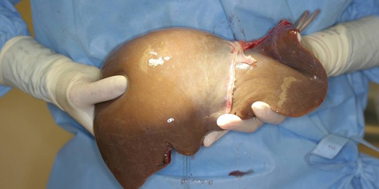 Karaciğeri de tutukladılar!