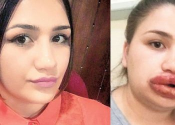 Merve Keleş adlı genç kadın silikon mağduru oldu