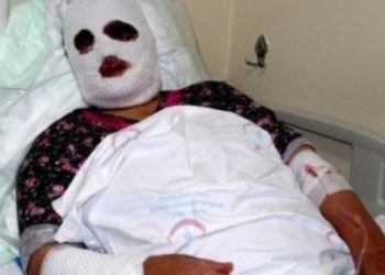 ​Lavabo açıcıya sıcak su döken kadının yüzü feci şekilde yandı