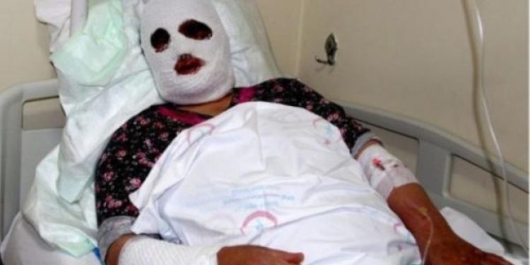 Lavabo açıcıya sıcak su döken kadının yüzü feci şekilde yandı