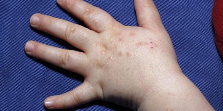 El ayak ağız hastalığı nedir? Yakalananların sayısı artıyor