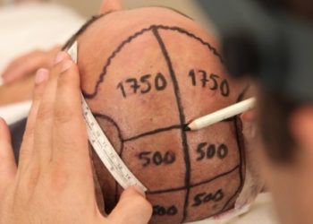 Saç ekimi merdiven altına düştü