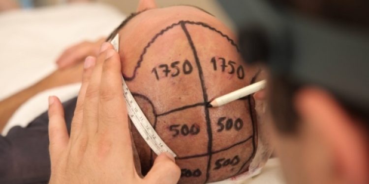 Saç ekimi merdiven altına düştü