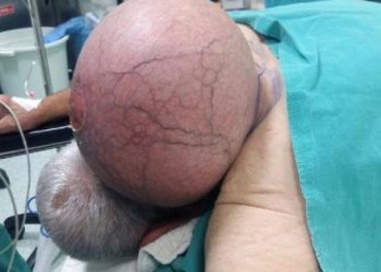 ​50 Yıldır ensesinde taşıdığı kitle, doktorları bile hayrete düşürdü