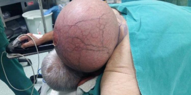 ​50 Yıldır ensesinde taşıdığı kitle, doktorları bile hayrete düşürdü
