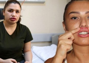 ​Kadınların dudaklarına inşaat silikonu enjekte etmiş