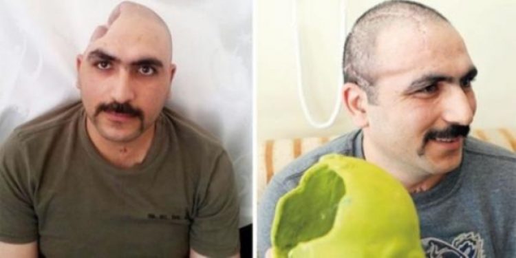 3D teknolojisi ile kafatasına kavuştu