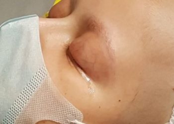 OHAL’le babası hapse giren Eray kanser tedavisine cevap vermiyor..