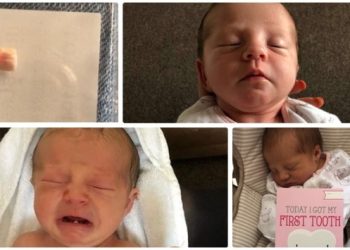 Dünyada ilk: Henüz 12 günlük bebeğin dişi çekildi