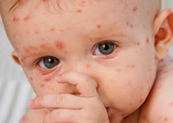 Karşı kampanyanın bilançosu: Kızamık 9 kat arttı