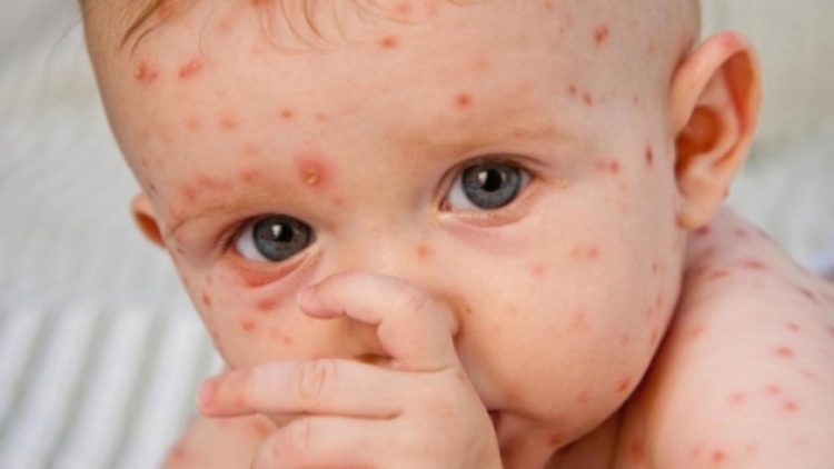 Karşı kampanyanın bilançosu: Kızamık 9 kat arttı