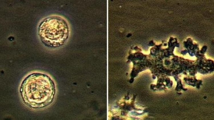 Beynini amipler yedi!