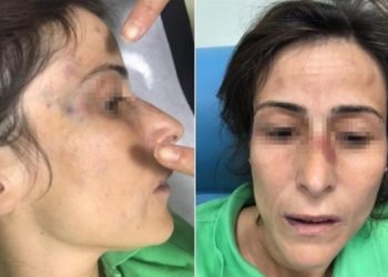 Eşinin kemiklerini kıran doktora ‘takdir indirimi’