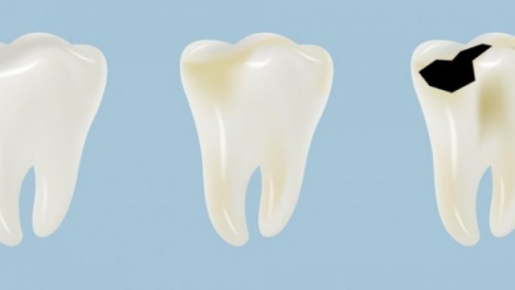 Diş çürümesi tarihe karışıyor