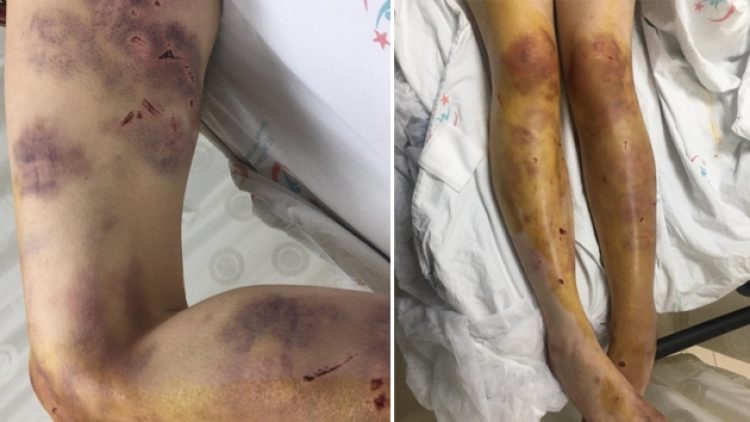 Suriye’de savaştan kaçtı; imam nikâhlı kocası kerpetenle ayak tırnaklarını çekti, zincirle dövdü!