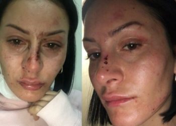 Polisin dövdüğü kadın: Doktor ‘Az bile benzetmişsiniz’ dedi