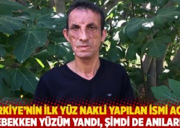 Türkiye’nin ilk yüz nakli yapılan ismi Acar: Bebekken yüzüm yandı, şimdi de anılarım