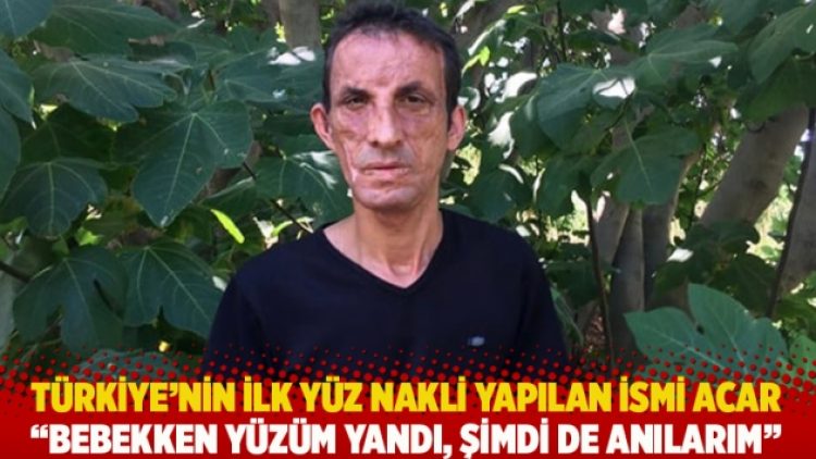 Türkiye’nin ilk yüz nakli yapılan ismi Acar: Bebekken yüzüm yandı, şimdi de anılarım