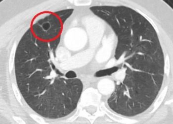 Dünya tıp literatüründe bir ilk: Covid-19, akciğer kanserini taklit etti