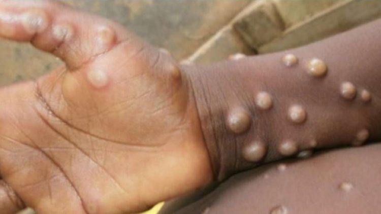 ‘Maymun çiçeği’ hastalığı hakkında neler biliniyor?