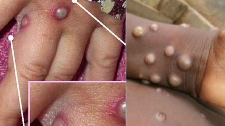 Maymun çiçeği virüsü: Üç ülkede daha yeni vakalar tespit edildi