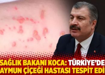 Sağlık Bakanı Koca: Türkiye’de 5 maymun çiçeği hastası tespit edildi