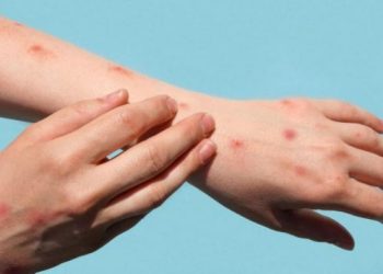 Almanya’da 4 yaşındaki çocuğa maymun çiçeği virüsü bulaştı