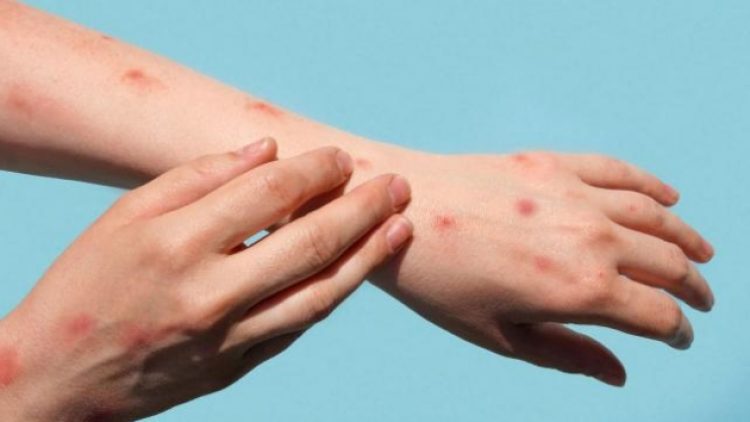 Almanya’da 4 yaşındaki çocuğa maymun çiçeği virüsü bulaştı