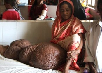 Begüm’ün bir bacağı 60 kilo oldu!