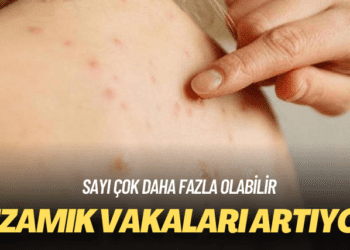 Sayı çok daha fazla olabilir: Kızamık vakaları artıyor