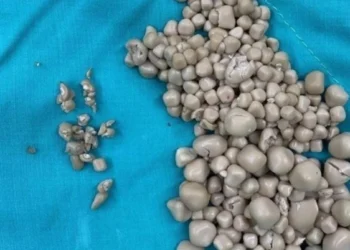 Sırt ağrısıyla hastaneye gitti! Vücudundan yüzlerce taş çıktı