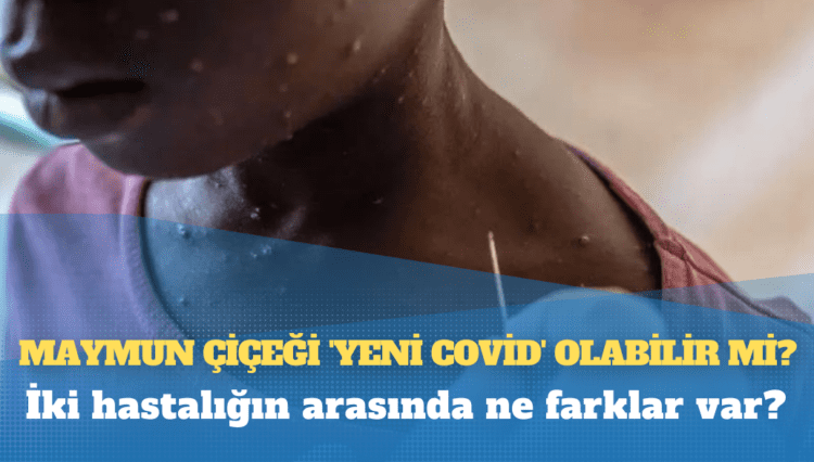 Maymun çiçeği ‘yeni Covid’ olabilir mi, iki hastalığın arasında ne farklar var?