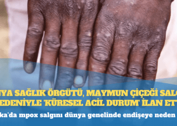 Dünya Sağlık Örgütü, maymun çiçeği salgını nedeniyle ‘küresel acil durum’ ilan etti