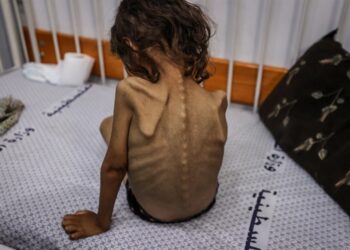 Kitlesel açlığın yaşandığı Gazze’deki doktor: Böyle şeyleri kitaplarda okurduk şimdi birebir şahit oluyoruz