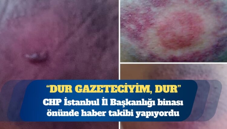 Gazeteci Fatoş Erdoğan: İl başkanlığından üç plastik mermi morluğuyla eve döndüm