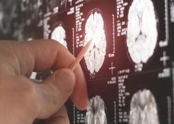 ”Çaresi yok” denilen Huntington hastalığına tedavi geliştirildi