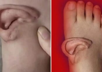 Kulak, ayağa nakledilerek kurtarıldı