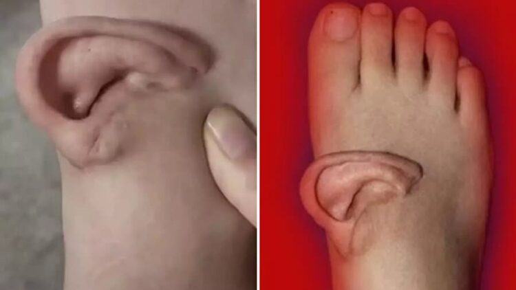 Kulak, ayağa nakledilerek kurtarıldı