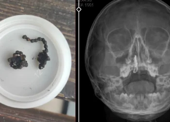 5 yaşındaki çocuk, 2 yıl burnunda tırnak makası zinciriyle yaşadı